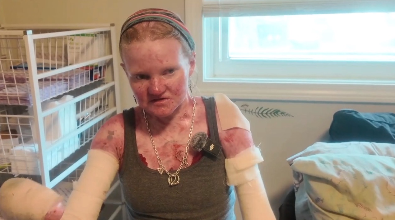 St. Clair Shores woman with rare skin disorder hopeful for life-changing power chair